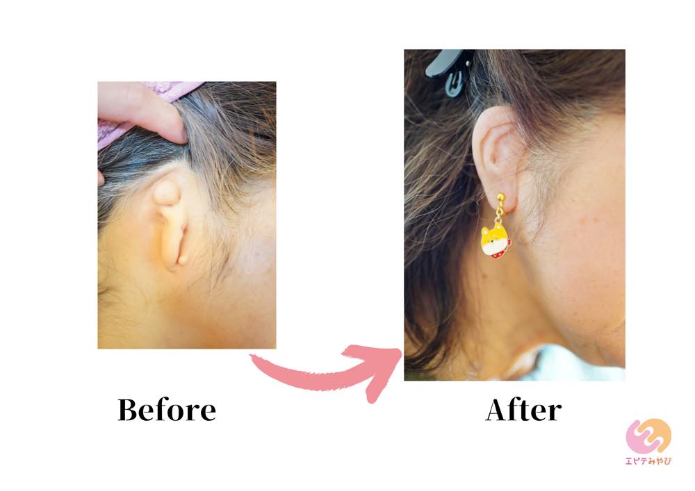 Client with anotia wearing an ear epithesis fitted with an earring